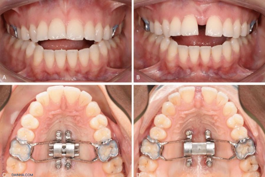 Tại ngày học này, các học viên sẽ được hướng dẫn thêm về cách sử dụng thành thạo khí cụ MARPE để nong xương hàm.