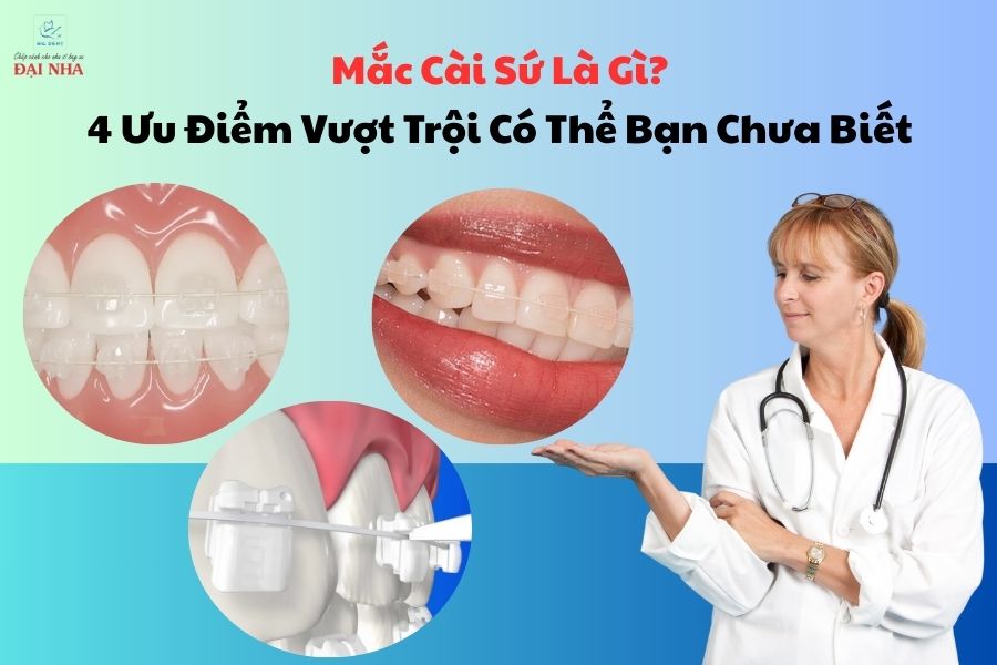 Mắc cài sứ là gì? 4 ưu điểm vượt trội