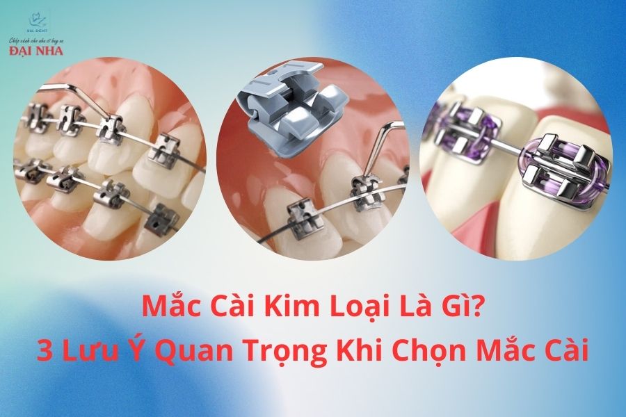 Mắc cài kim loại là gì?