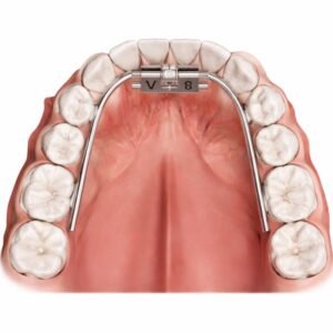 Ốc nong hàm dưới