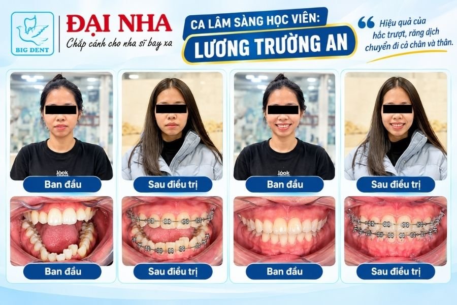 ca lâm sàng thành công khi học chỉnh nha