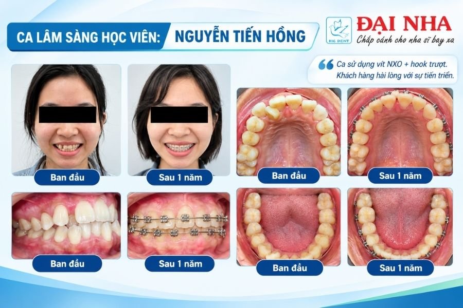 ca lâm sàng thành công khi học chỉnh nha